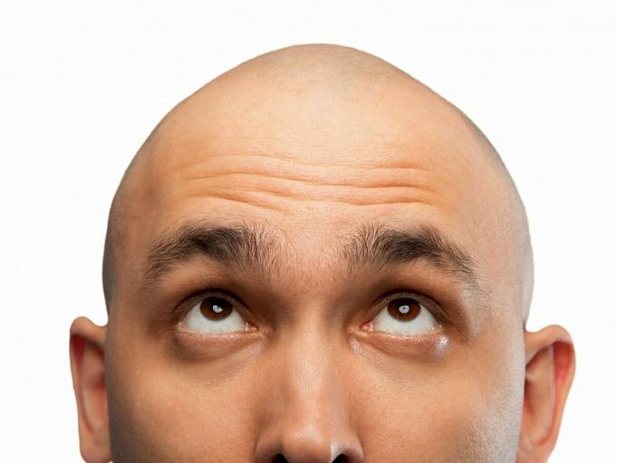 Perücken Für Glatze. Die Beste Lösung Gegen Haarausfall